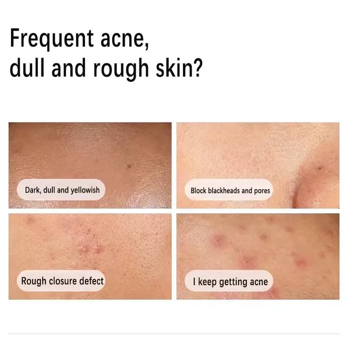 Sérum niacinamide 10% zinc 1% face control sébum acné peau grasse pores resserrés éclatant visage beauté santé skincare face serum the ordinary