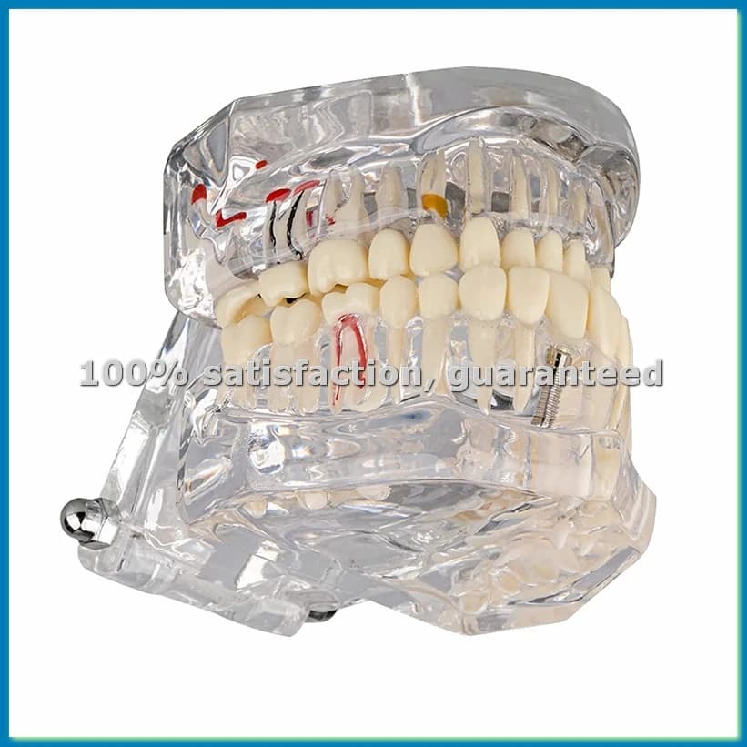 Modèle dentaire transparent de maladie dentaire avec pont d'implants, modèle dentaire pour l'éducati