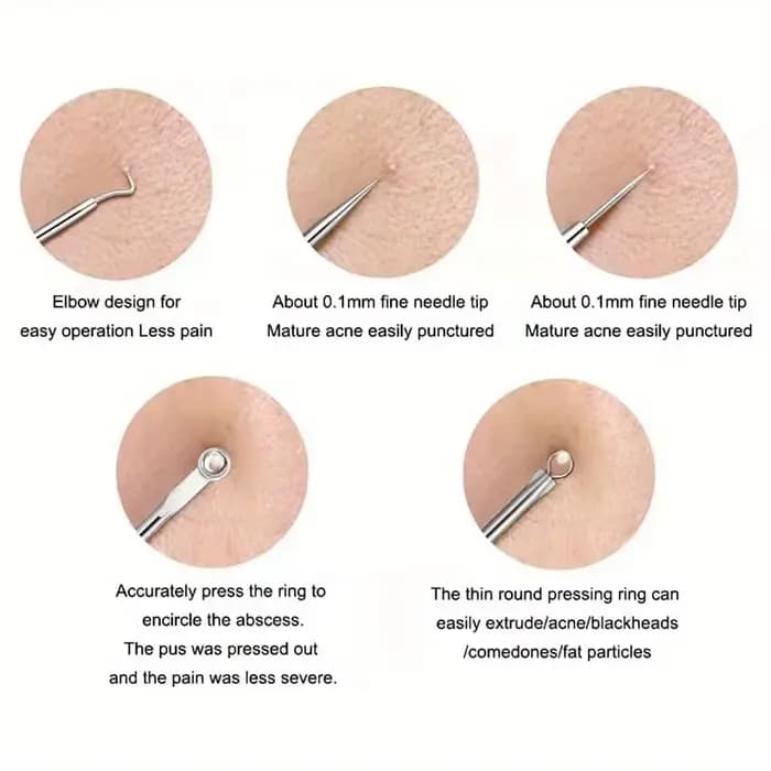 Kit d'extraction d'imperfections de boutons et d'acné, points noirs, aiguilles en acier inoxydable,